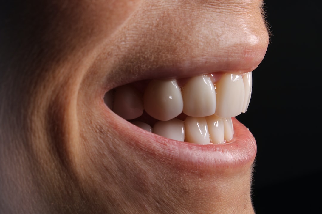Porcelain Veneers in Berkeley: Cost, Process, and What to Expect